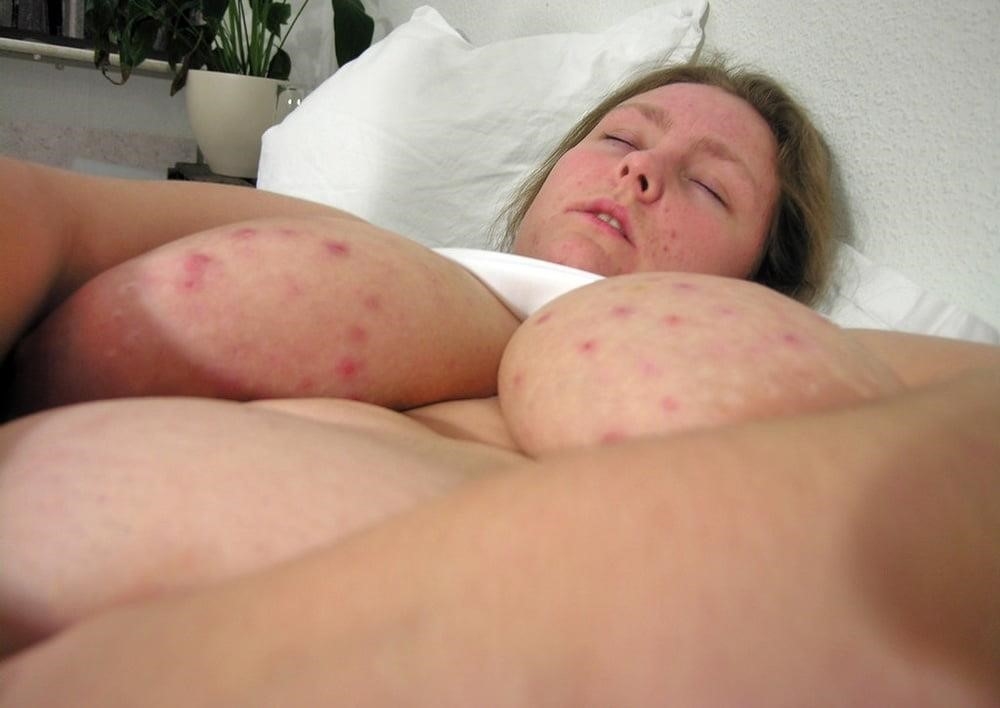 Does masturbation help with acne-6786